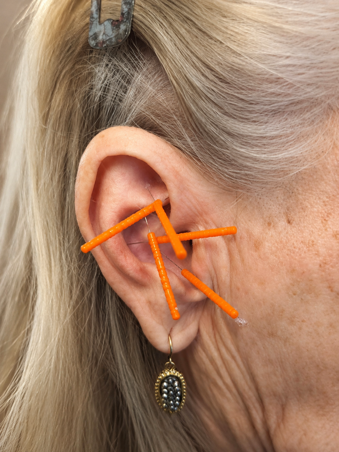 Detailed close-up of Acudetox ear acupuncture points