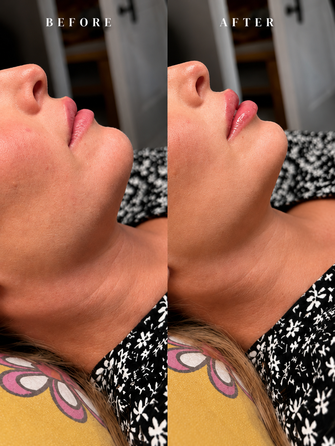 Dermal filler before and after lip enhancement result