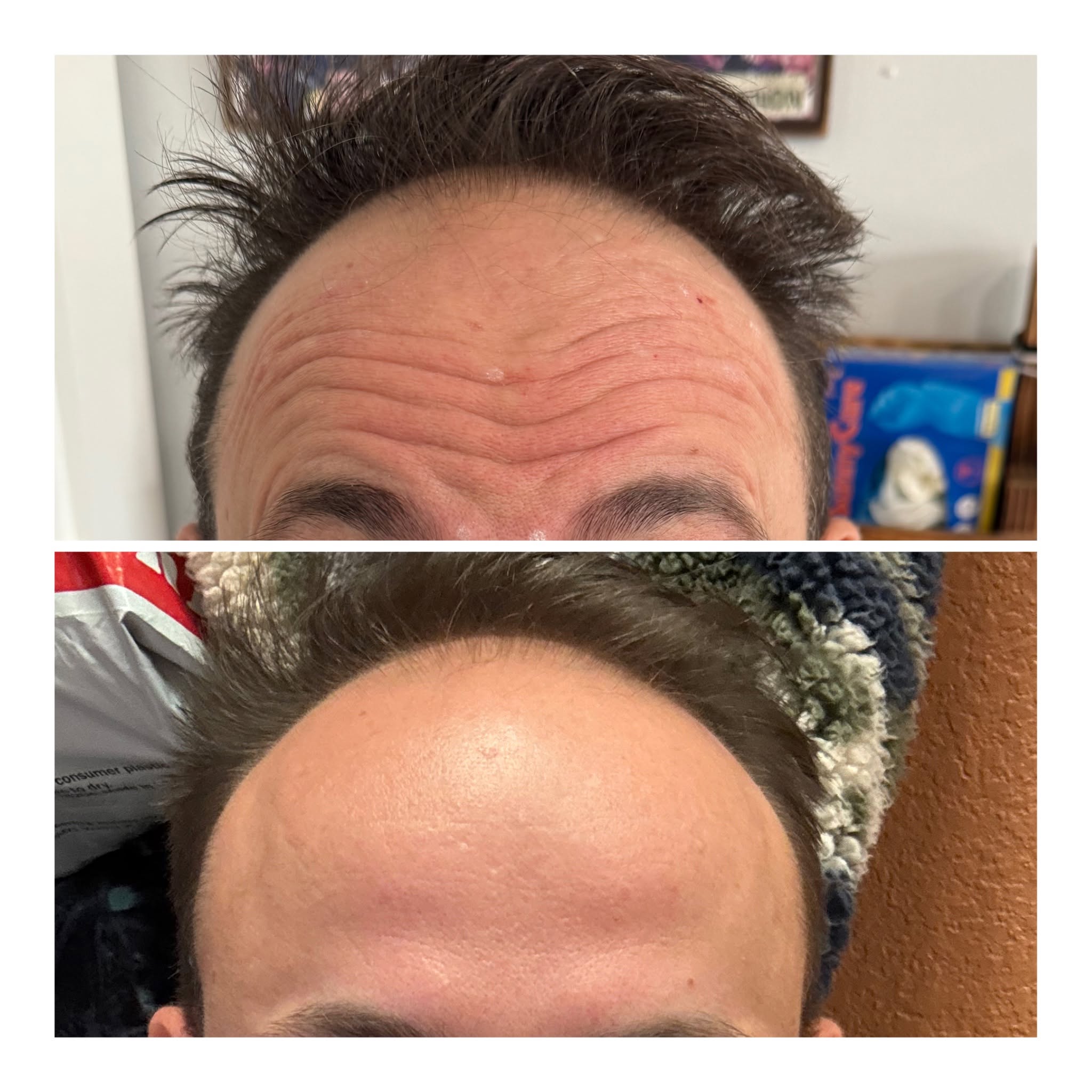 Forehead neurotoxin before and after smoothing result